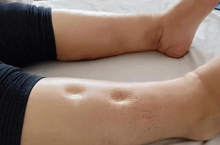 신장 붓기 증상 왜 생기나? 몸이 보내는 신호