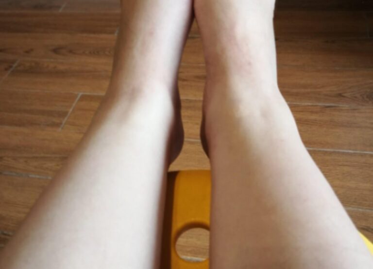 다리 부종 원인 3분으로 확인하는 부종 위험 신호