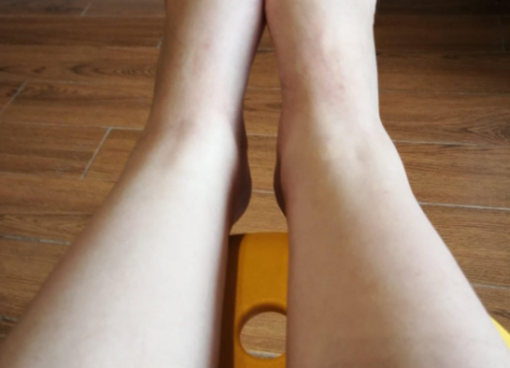 다리 부종 원인 3분으로 확인하는 부종 위험 신호